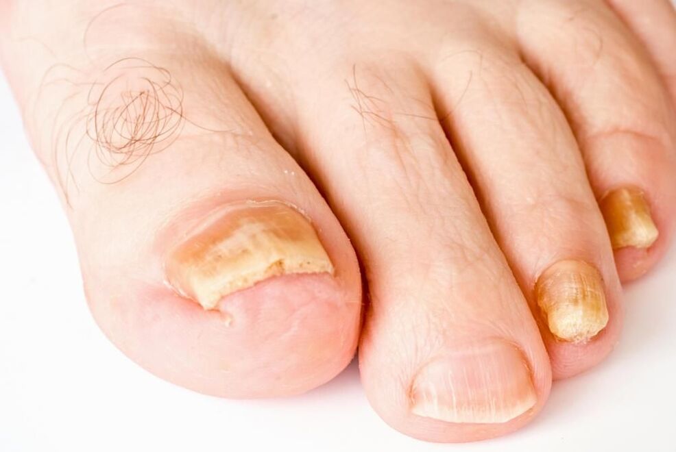 primele semne ale ciupercii unghiilor de la picioare